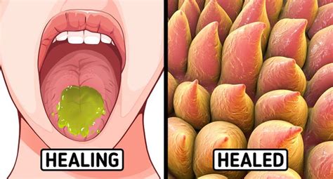 10 Ways To Heal A Burnt Tongue After Eating Hot Food Bright Side