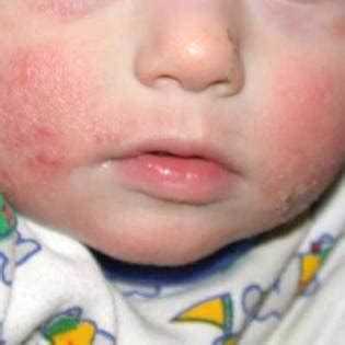 When you eat an ingredient or type of food that your body perceives as an allergen, your body's defense may cause a rash or. Pictures of Skin Allergies in Children