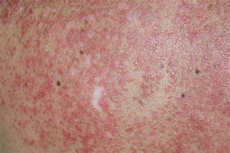 Lupus Rash On Back Triggered By Sun Photograph By Dr P Marazziscience