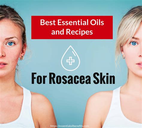 Best Essential Oil And Recipes For Rosacea Skin Essential Oil Benefits