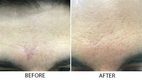 Scar Reduction Bismarck Nd Pure Skin Aesthetic And Laser Center