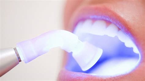 Is Laser Teeth Whitening An Option For You Colgate SG