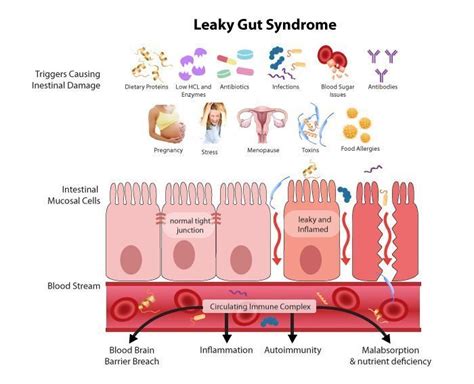 Leaky Gut Syndrome Symptoms Causes Tests And Treamtenets