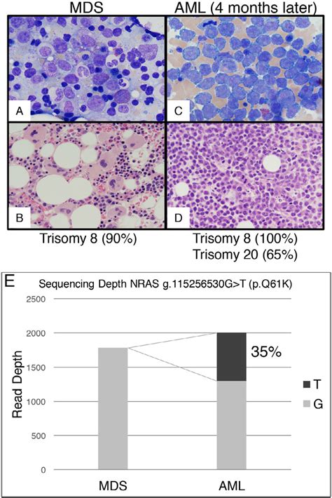 Histology Of Bone Marrow A And B Mds At The Time Of Presentation To