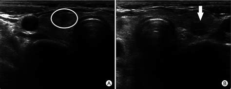 Ultrasonography For The Thyroid Gland Revealed The Diffuse Enlarged