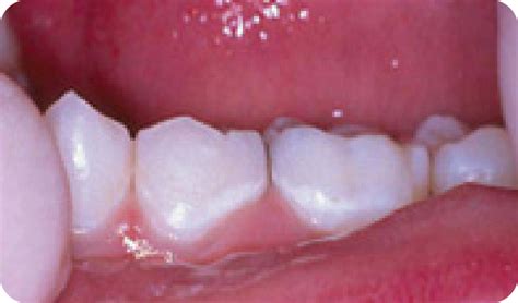 How To Remove White Spots On Teeth Check Spelling Or Type A New Query