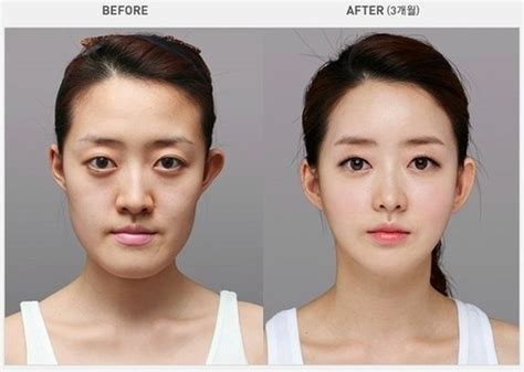 Korean Plastic Surgery 31 Pics