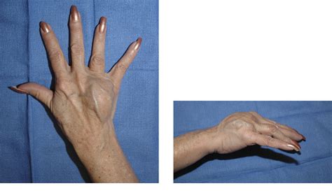 Figure 1 From Reconstruction Of An Entire Metacarpal And