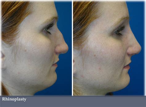 A Surgical Vs Non Surgical Nose Job Vargas Face And Skin Center