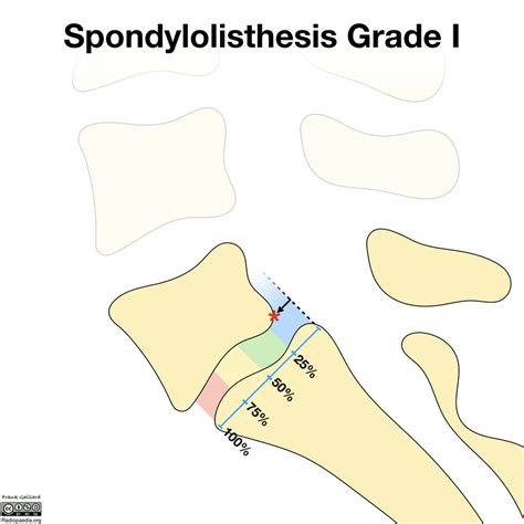 Spondylolisthesis Causes Symptoms And Treatment Csc
