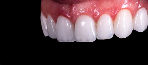 Veneer Materials Whats The Best Dental Veneer Material For You