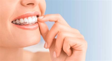 Braces Dentists In North Ryde North Ryde Dentistry