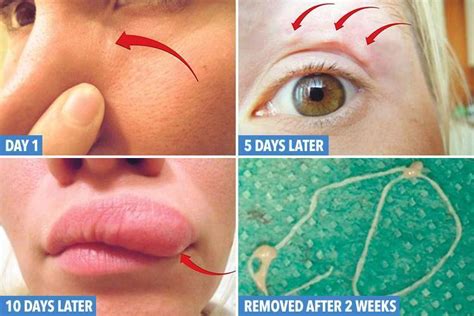 Itchy Lump On Womans Face Is Actually Parasitic Worm Crawling Under