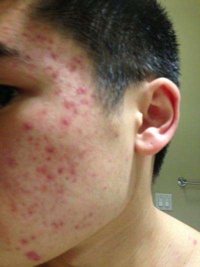 I Cant Tell How Bad My Acne Scarring Is Photo Doctor