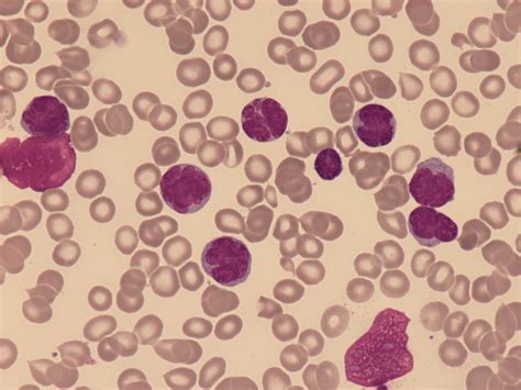 Adult T Cell Leukaemialymphoma Atll
