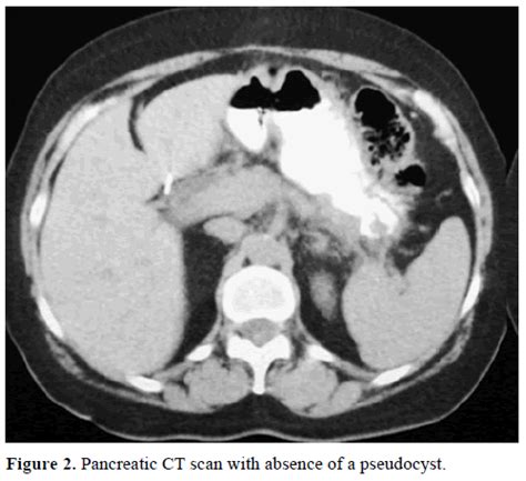 Recurrent Pancreatic Pseudocyst Diagnosed 9 Years After