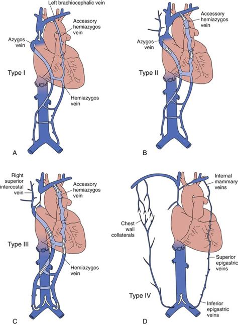The azygous vein represents an important collateral system of the svc and. Superior Vena Cava Obstruction | Thoracic Key