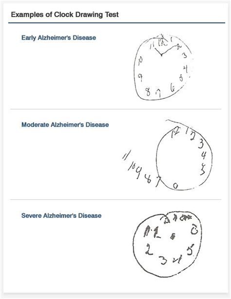 Nasreddine, ziad s., et al. drawing clock | Clock drawings