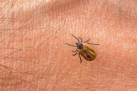 Tick Filled With Blood Crawling On Human Body Skin Stock Photo Image