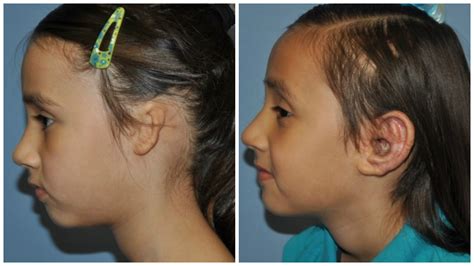 Unilateral Microtia After Medpor Outer Ear Reconstruction The