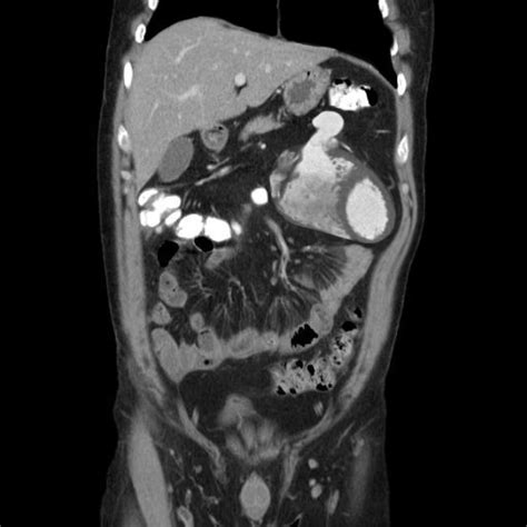 Ectopia Cordis Interna Tin Man Syndrome Radiology Case