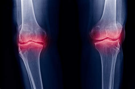 Radiographic Changes Of Osteoarthritis Associated With Persistent Knee