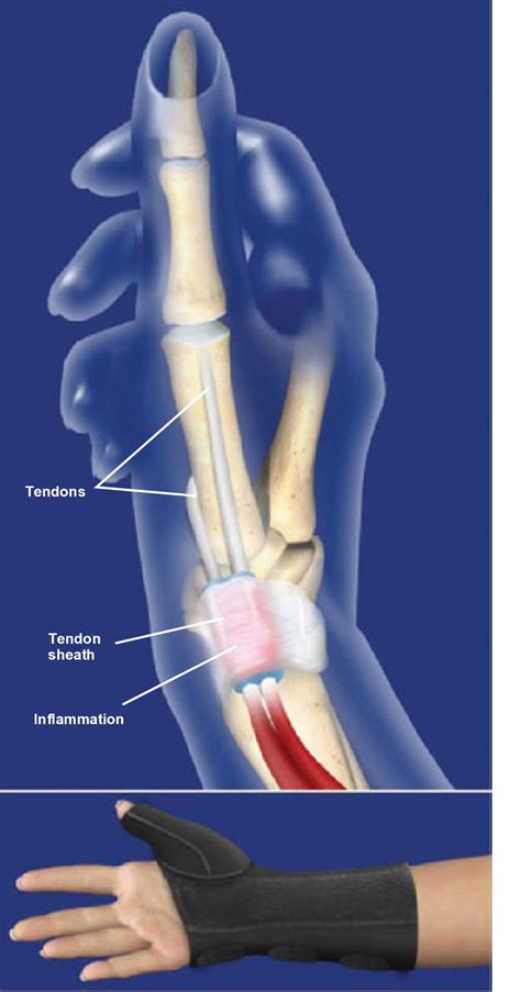 What Is De Quervain S Tenosynovitis Images And Photos Finder