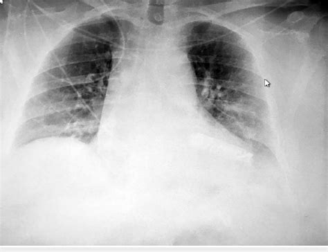 Follow Up Chest X Ray Showing Significant Improvement With Resolution