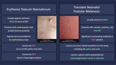 Erythema Toxicum Neonatorum Pictures Symptoms Causes Treatment Kulturaupice