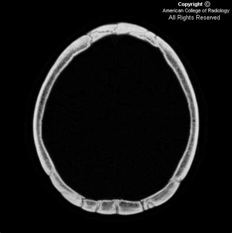 Neuroradiology On The Net Wormian Bones