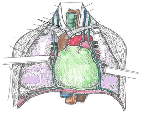 Because the left lung does not contact the anterior portion of the left thoracic cavity at this level, the heart with its epicardial fat occupies this space. Chest Cavity Anatomy