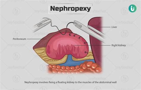 Nephropexy Procedure Purpose Results Cost Price Indications Recovery