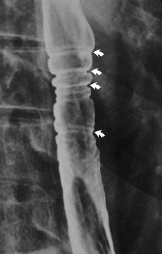 Radiologic Diagnosis Of Benign Esophageal Strictures A Pattern