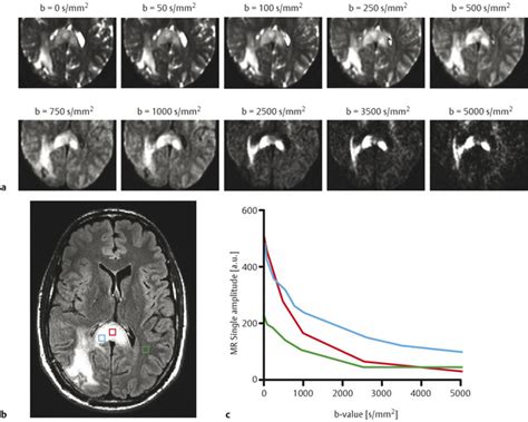 Diffusion Weighted Imaging For Gliomas Radiology Key