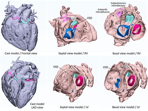 Frontiers 3d Modeling And Printing In Congenital Heart Surgery