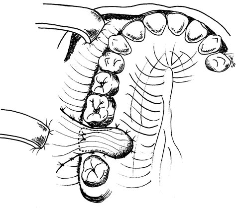 Modified Double Layered Flap Technique For Closure Of An Oroantral