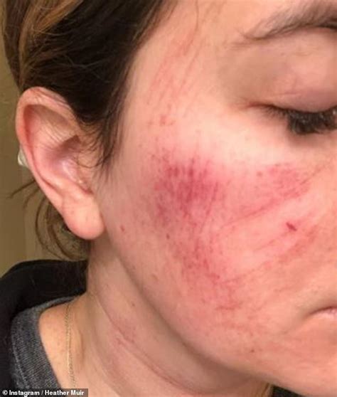 Distraught Woman Shares Photos Of Her Scratched Skin After A Red