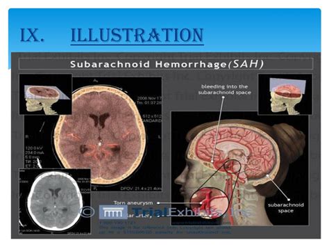 Ppt Subarachnoid Hemorrhage Powerpoint Presentation Id2959092 239