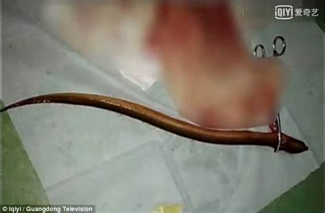 Man Puts Eel In His Anus To Treat Constipation Daily Mail Online