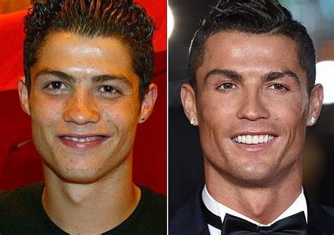 Cristiano Ronaldo Before And After Plastic Surgery