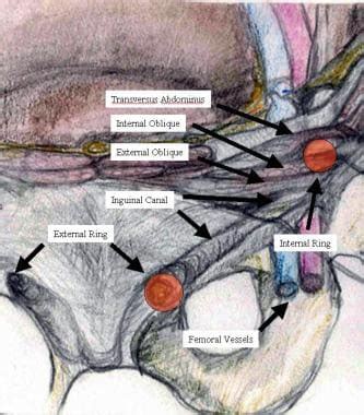 Inguinal Hernia Repair Mesh