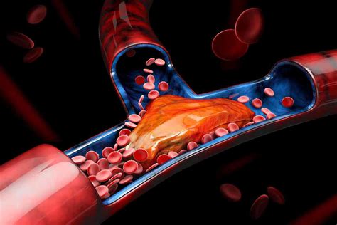 Blood Clots 6 Warning Signs You Should Never Ignore World Today News
