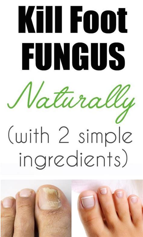 Simple Home Remedy To Remove Toenail Fungus Home Remedies Toenail