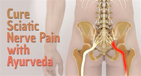 Maurya ayurveda hospital, the leading ayurveda treatment, and rehabilitation center in kerala, india. How to Cure Sciatica Nerve Pain in Ayurveda? - SureShot ...