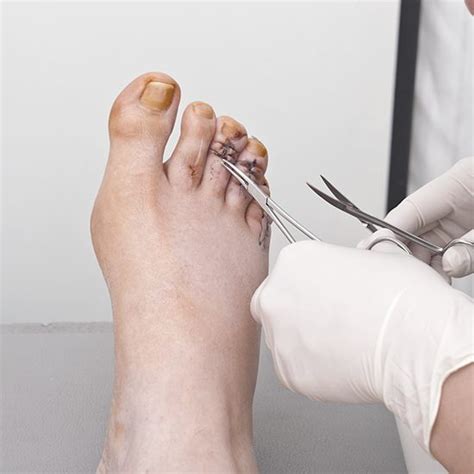 Hammertoe Surgery Specialist Foot Doctor Jaws Podiatry