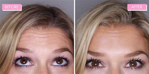 What To Know About Forehead Botox Before And After The Source Full