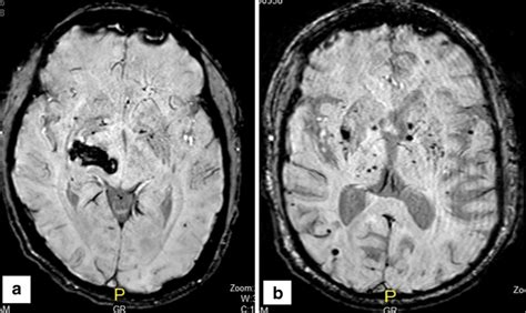 Localization Of A Cerebral Microbleed A And B The Mri Of The Patient