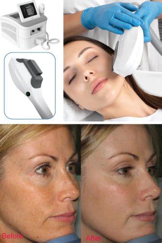 Ipl Machine For Skin Rejuvenation Bestview Laser Pdf Catalogs