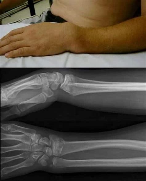 Colles Fracture • Litfl • Medical Eponym Library