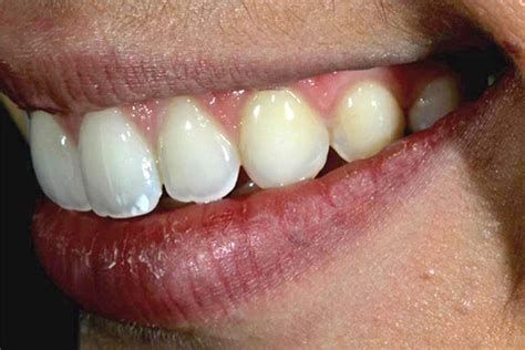 Teeth Stain Types And How To Remove It Bali Dental Voyage